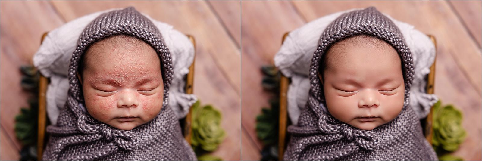 comparisation of baby with and without newborn acne
